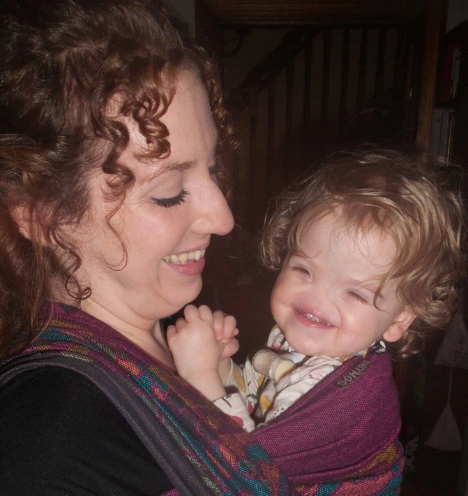 (تصاویر) دختری که بدون بینی به دنیا آمد