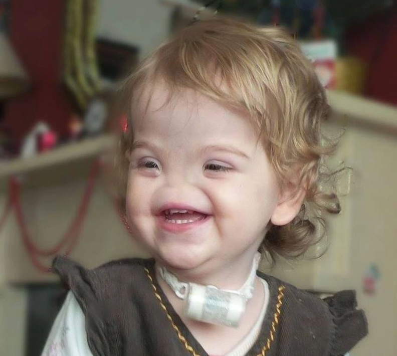 (تصاویر) دختری که بدون بینی به دنیا آمد