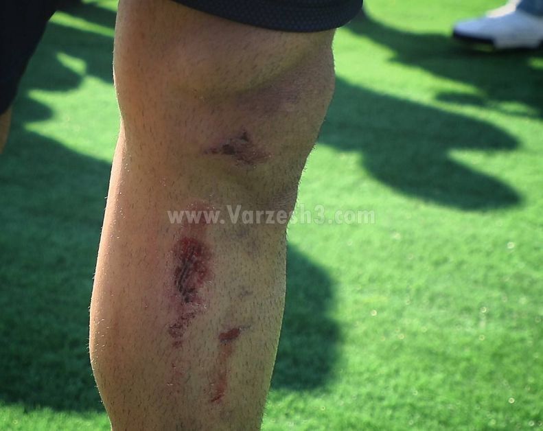 (عکس) وضعیت وخیم زانوی بیرانوند پس از مصدومیت (عکس) وضعیت وخیم زانوی بیرانوند پس از مصدومیت