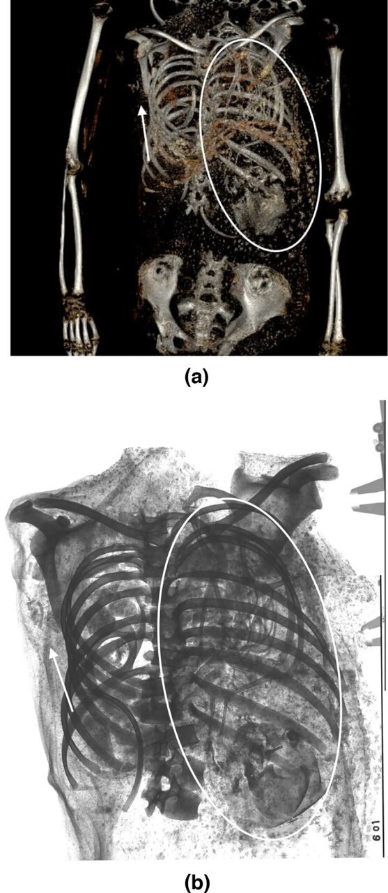 (عکس) سرنوشت وحشتناک مومیایی دختر جوان مصری (عکس) سرنوشت وحشتناک مومیایی دختر جوان مصری