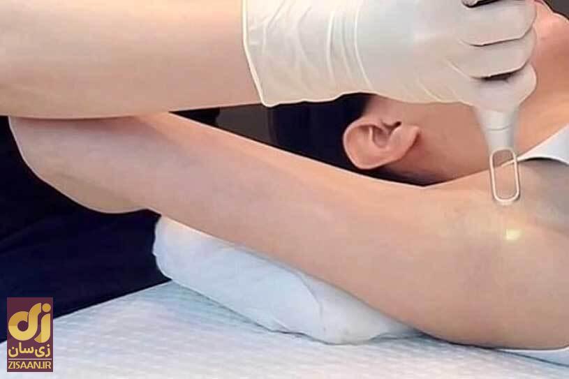 رفع تیرگی زیر بغل با چند روش خانگی فوق‌العاده + دلایل سیاهی زیر بغل