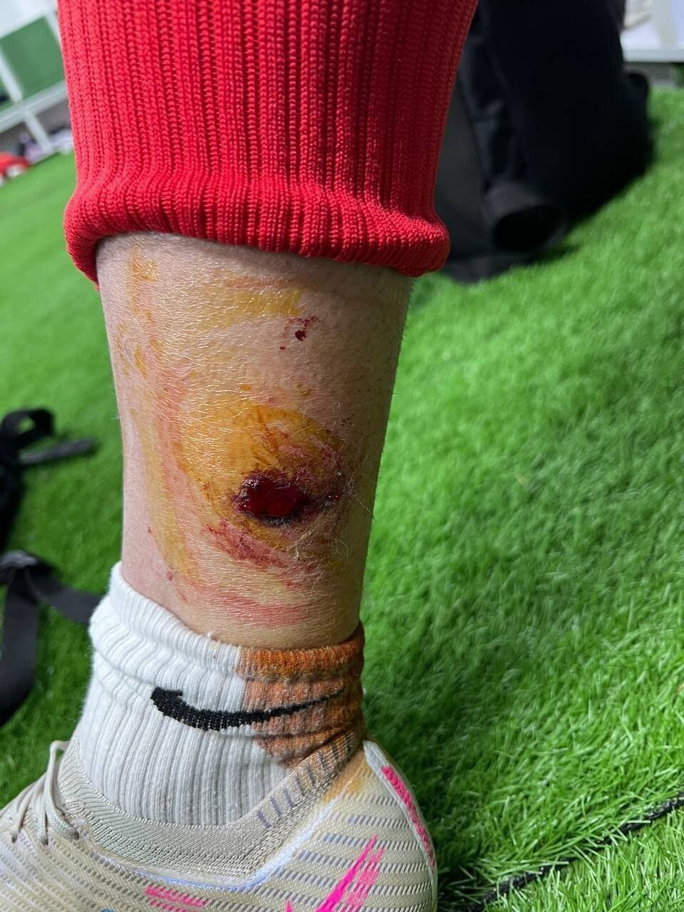 (عکس+16) مصدومیت یک پرسپولیسی با پرتاب نارنجک (عکس+16) مصدومیت یک پرسپولیسی با پرتاب نارنجک