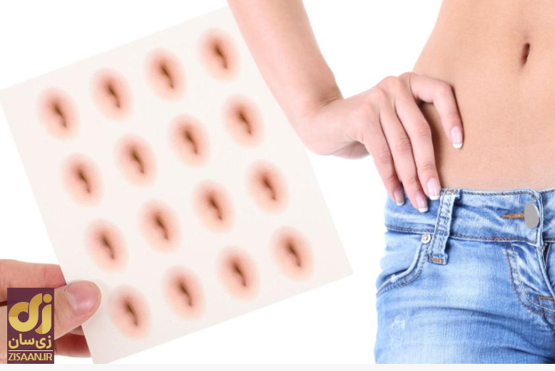 ناف تقلبی. عمل جراحی زیبایی