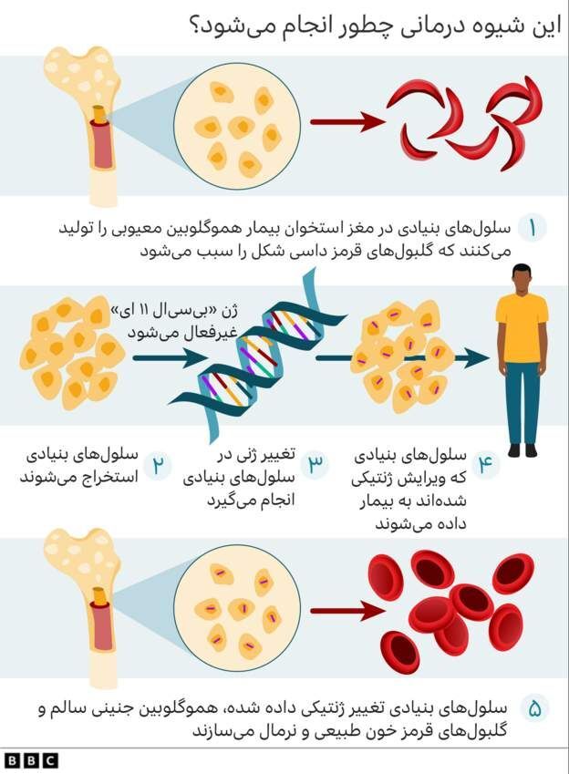 خبر خوش برای بیماران ژنتیکی؛ اولین روش «ژن درمانی» در جهان تایید شد