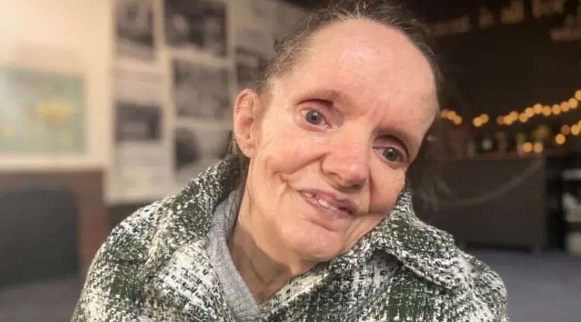 امیدی تازه برای خواهرانی که در بدن خود به دام افتادهاند امیدی تازه برای خواهرانی که در بدن خود به دام افتادهاند