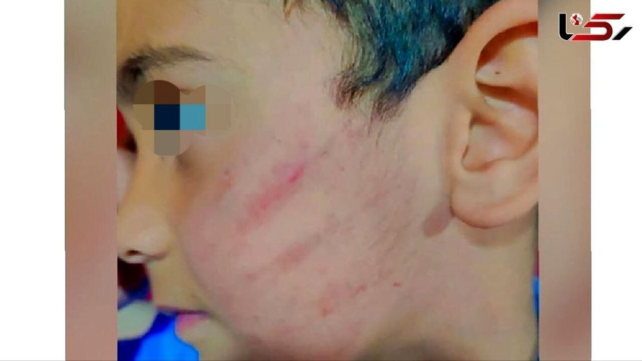 تصویر صورت کتک‌خورده یک دانش آموز دبستانی خبرساز شد + عکس