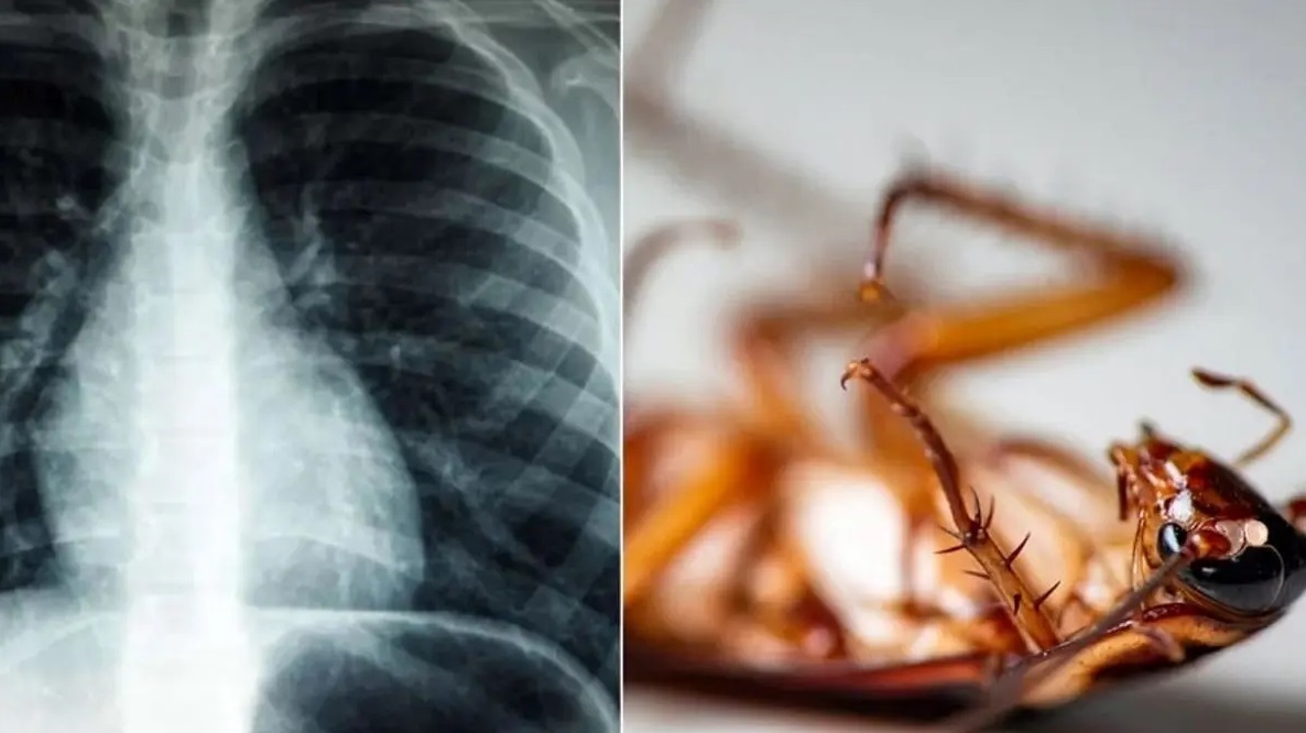 باورنکردنی؛ سوسک ۴ سانتیمتری که در ریه یک هندی زندگی میکرد باورنکردنی؛ سوسک ۴ سانتیمتری که در ریه یک هندی زندگی میکرد