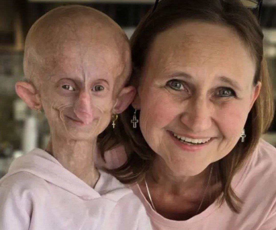 ستاره تیک تاکی مبتلا به پیری زودرس در ۱۹ سالگی درگذشت ستاره تیک تاکی مبتلا به پیری زودرس در ۱۹ سالگی درگذشت