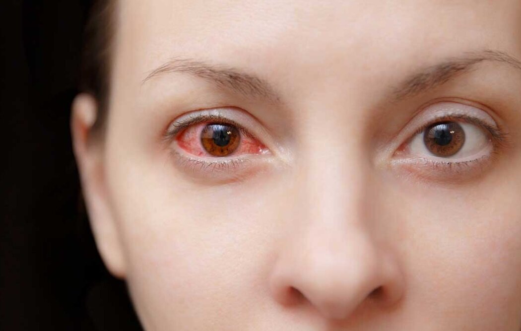 «اِلتون جان» چرا بینایی‌اش را از دست داد؟