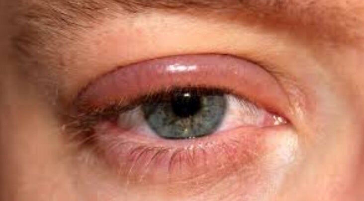 «اِلتون جان» چرا بینایی‌اش را از دست داد؟