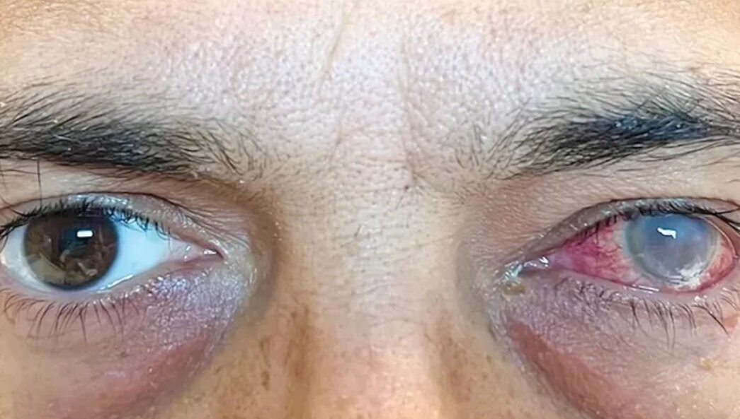 «اِلتون جان» چرا بینایی‌اش را از دست داد؟