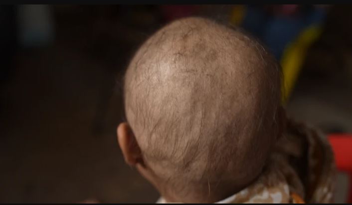 پدیده مرموز و عجیب ریزش شدید مو در غرب هند!