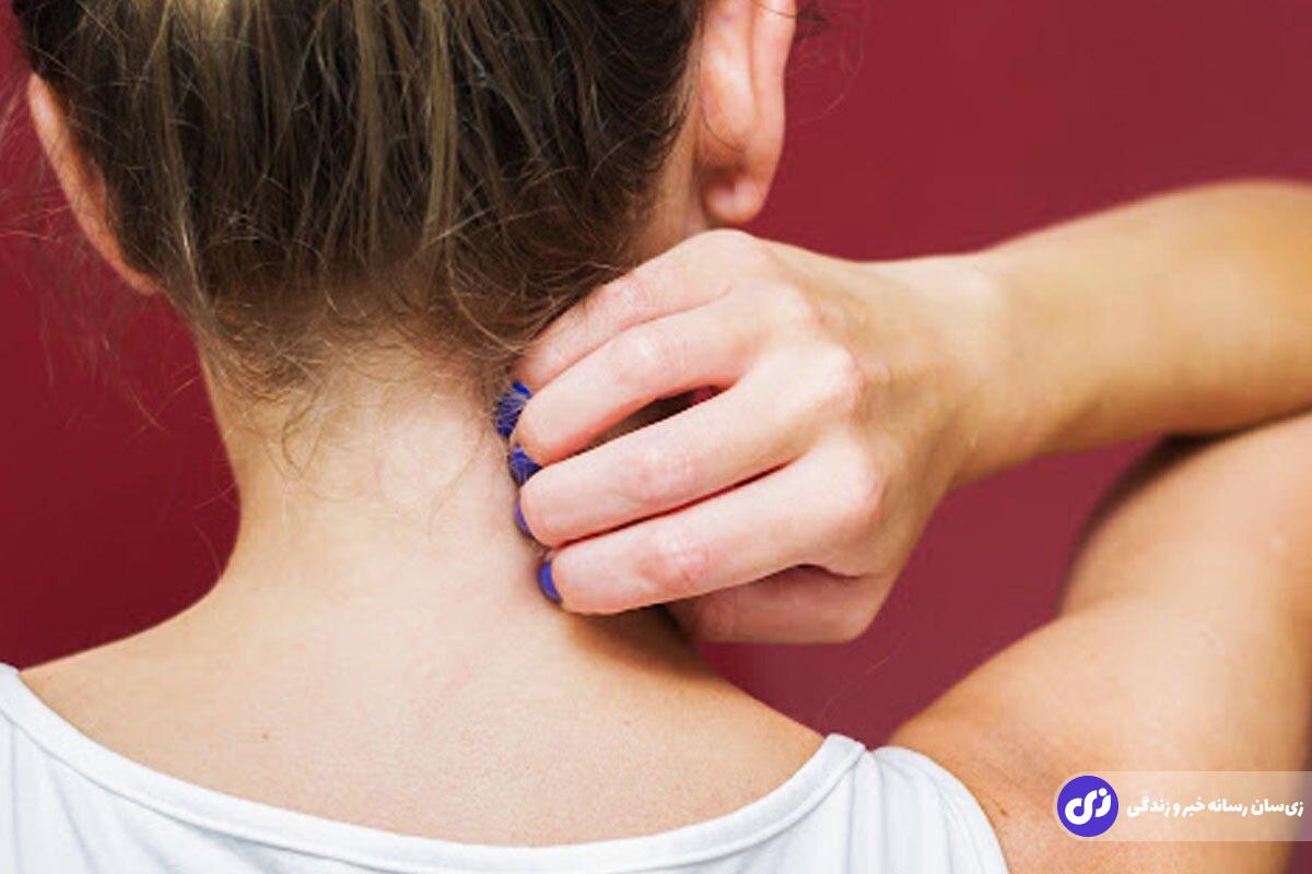 پاسخ دانشمندان به سوال مهم؛ آیا باید محل خارش را خاراند؟