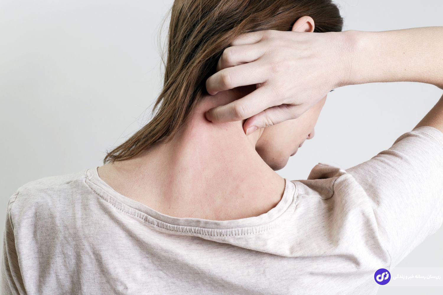 پاسخ دانشمندان به سوال مهم؛ آیا باید محل خارش را خاراند؟