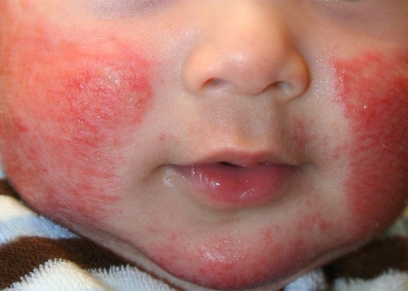 آیا حساسیت‌های غذایی دوران کودکی در بزرگسالی از بین می‌رود؟