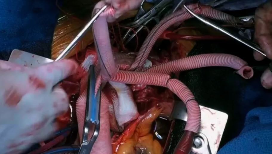 نجات جان یک زن با پیوند «خرطوم فیل منجمد» به قلب او