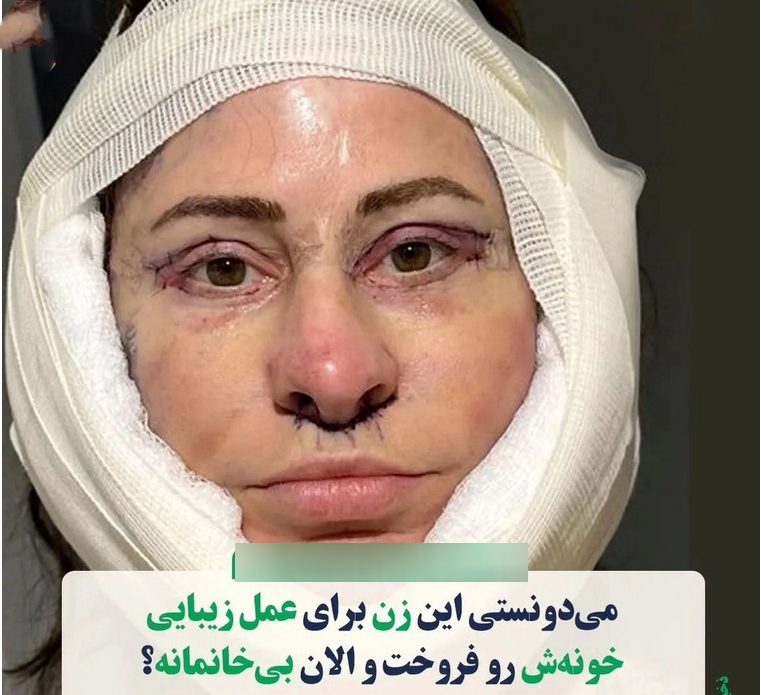 این زن بعد هزینه عمل زیبایی بی خانمان شد / ملکه زیبایی مصنوعی خیابانی شد! + عکس