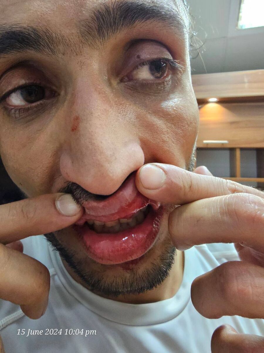 (عکس) وضعیت عجیب بازیکن سپاهان؛ لب سیاوش یزدانی ترکید!