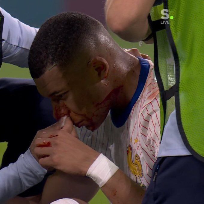 عکس| لحظه شکستن دماغ امباپه در بازی دیشب