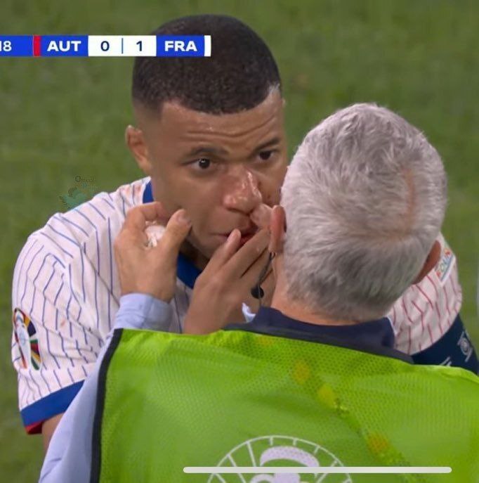 عکس| لحظه شکستن دماغ امباپه در بازی دیشب