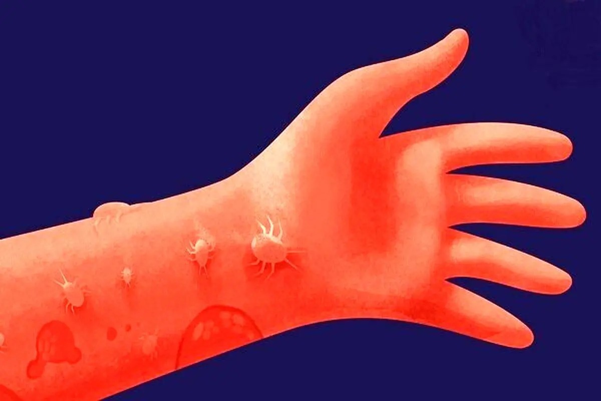 احساس حرکت حشره روی بدن نشانه کدام بیماری است؟