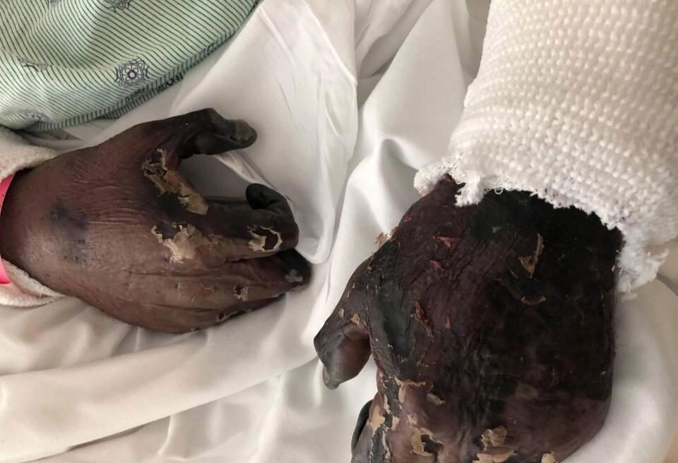 (تصاویر +18) بلای هولناکی که بیماری «گوشتخوار» بر سر انسان می‌آورد