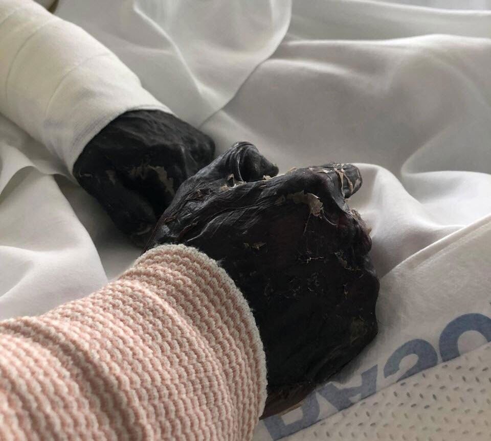 (تصاویر +18) بلای هولناکی که بیماری «گوشتخوار» بر سر انسان می‌آورد