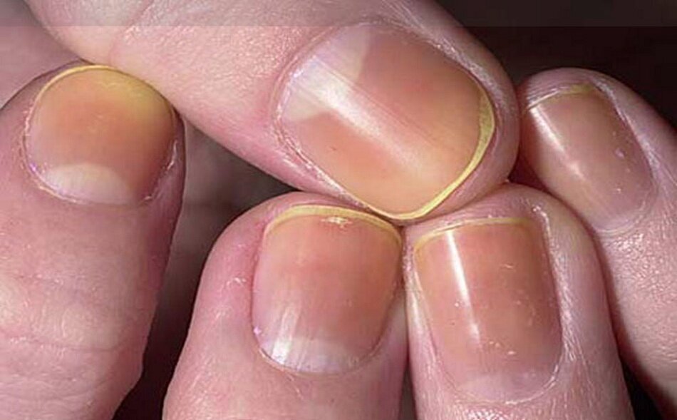 با نگاه کردن به ناخن خود از وضعیت سلامتتان مطلع شوید با نگاه کردن به ناخن خود از وضعیت سلامتتان مطلع شوید