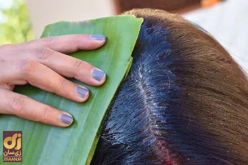 راه‌های درمان شوره سر چرب در خانه چیست؟