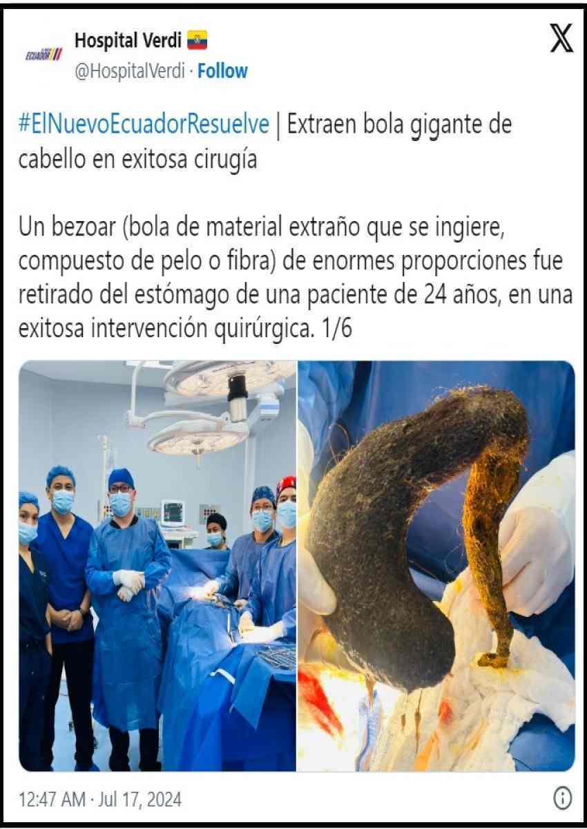 عکس| زنی که یک کیلو مو از معده اش بیرون کشیدند؛ سندرم راپونزل یا بیاختیاری موخوری چیست؟ عکس| زنی که یک کیلو مو از معده اش بیرون کشیدند؛ سندرم راپونزل یا بیاختیاری موخوری چیست؟