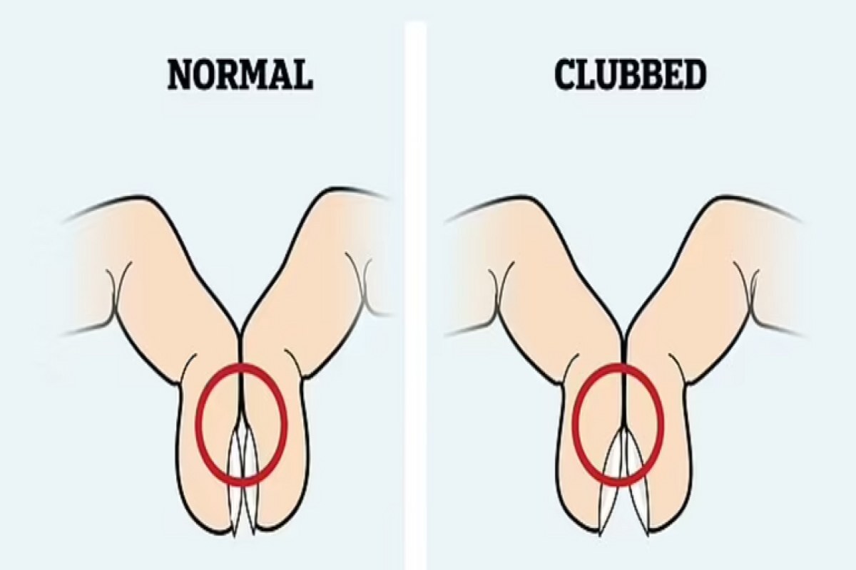 با نگاهی به انگشتانتان، این سرطان را زودتر تشخیص دهید