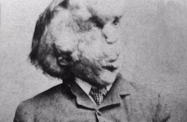 ۸ مورد از نادرترین بیماریهای جهان؛ از سندرم دست بیگانه تا سندرم مُرده متحرک ۸ مورد از نادرترین بیماریهای جهان؛ از سندرم دست بیگانه تا سندرم مُرده متحرک