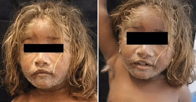 ۸ مورد از نادرترین بیماریهای جهان؛ از سندرم دست بیگانه تا سندرم مُرده متحرک ۸ مورد از نادرترین بیماریهای جهان؛ از سندرم دست بیگانه تا سندرم مُرده متحرک