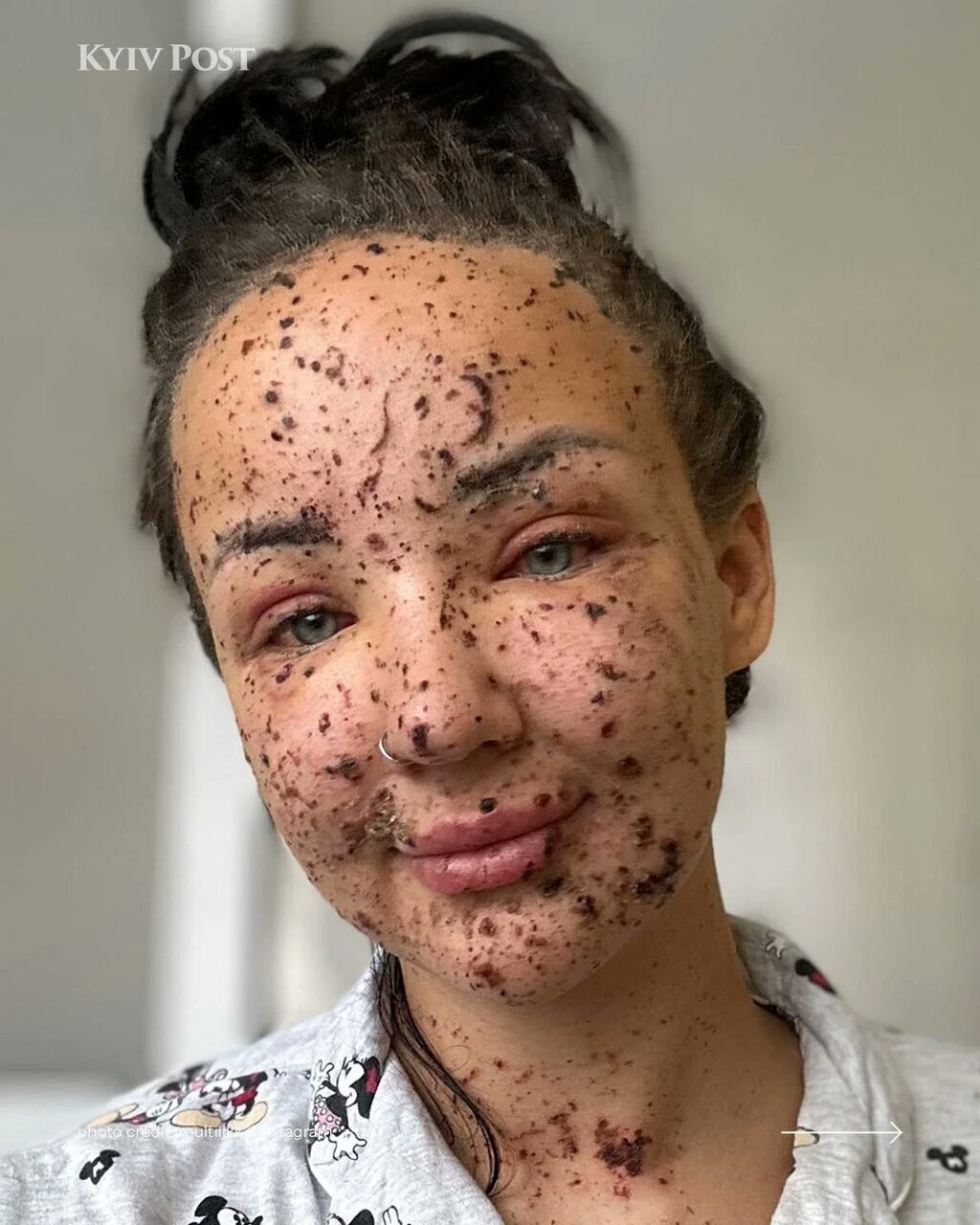 عکس | وضعیت صورت اپراتور زن یگان پهپاد ارتش اوکراین بعد از جراحت سنگین در خط مقدم!