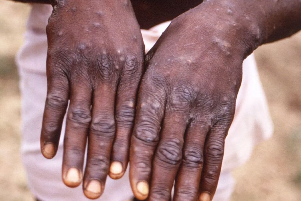 هشدار درباره یک بیماری مرگبار؛ ام‌پاکس یا آبله میمون چیست و چگونه منتقل می‌شود؟