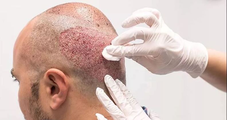 ترکیه چطور به مقصد بین‌المللی کاشت مو تبدیل شد؟