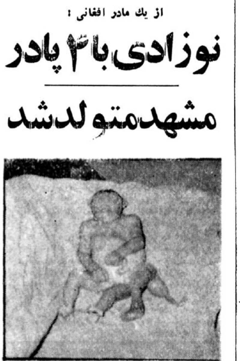 این زن افغان با به دنیا آوردن نوزادی ۴ پا همه را حیرتزده کرد! این زن افغان با به دنیا آوردن نوزادی ۴ پا همه را حیرتزده کرد!