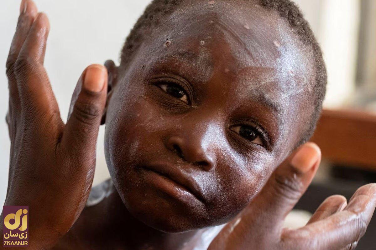 تفاوتهای آبله میمون و کرونا؛ جهان باز هم قرنطینه میشود؟ آبله میمون