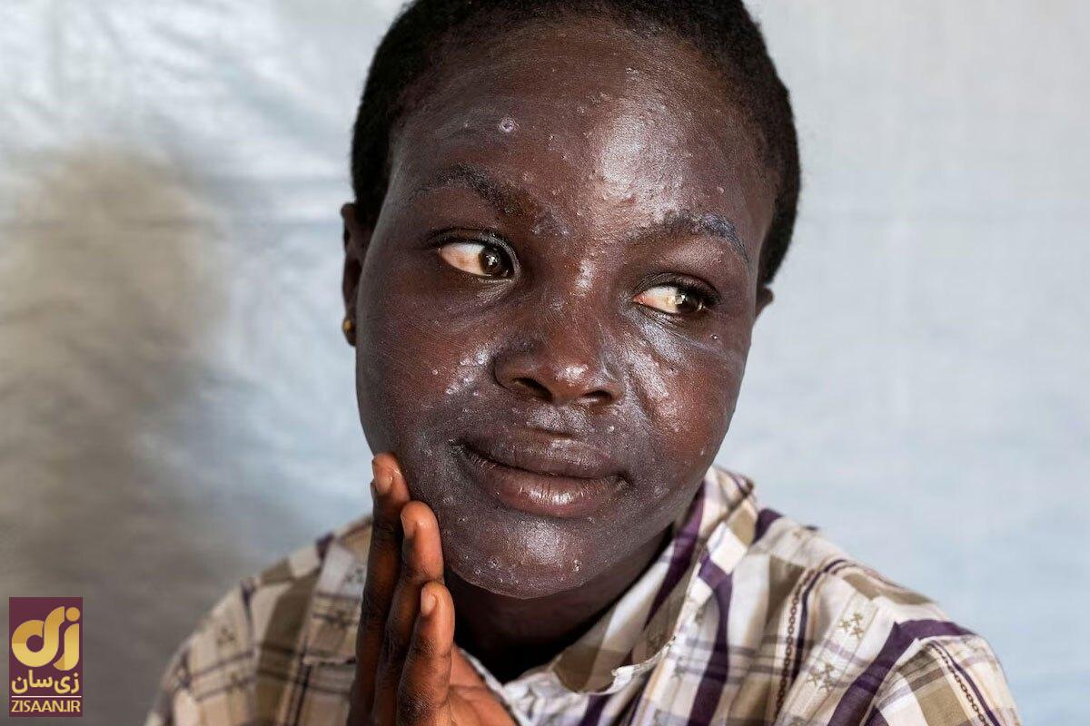 تفاوتهای آبله میمون و کرونا؛ جهان باز هم قرنطینه میشود؟ آبله میمون