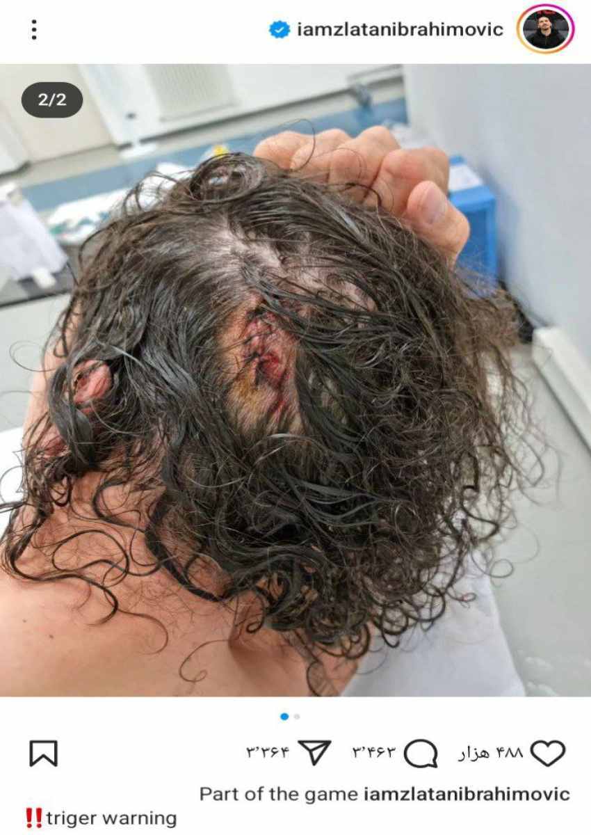 زلاتان ایبراهیموویچ دو سال پس از بازنشستگی مصدوم شد