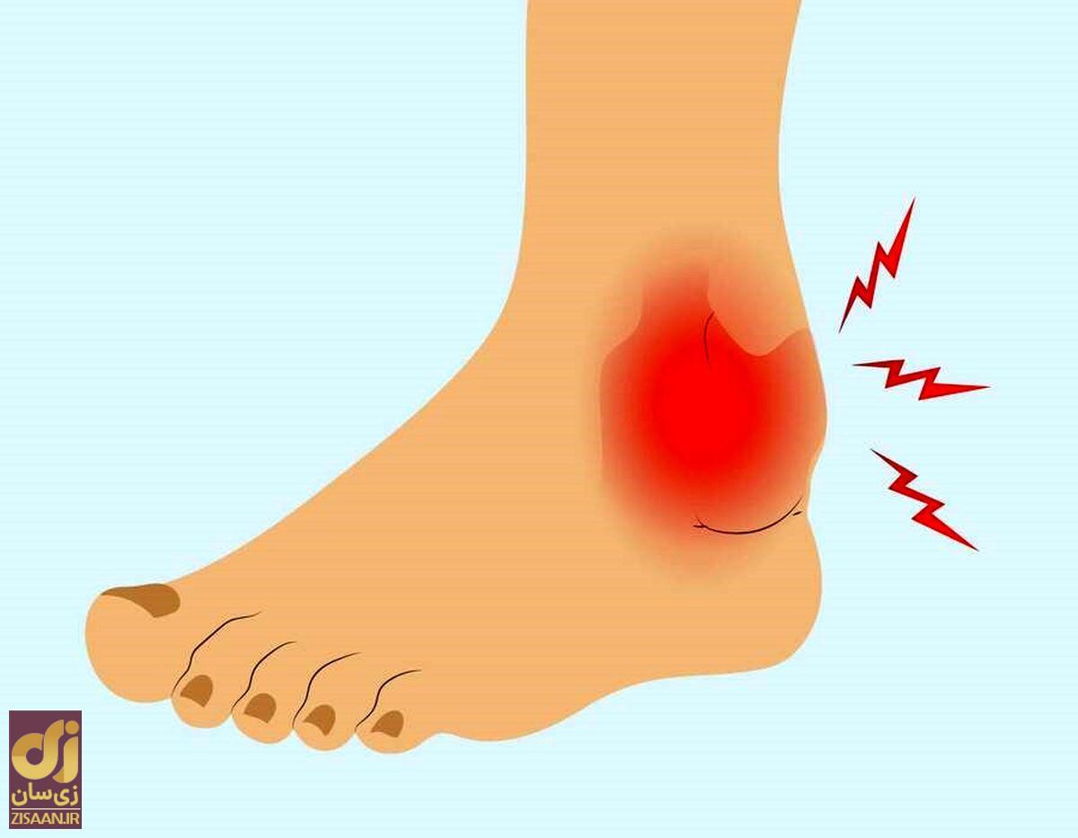 عوارض چاقی؛ اگر وزن کم نکنید این بیماریها شما را نابود میکنند! تصویر گرافیکی از آسیب دیدن مچ پا