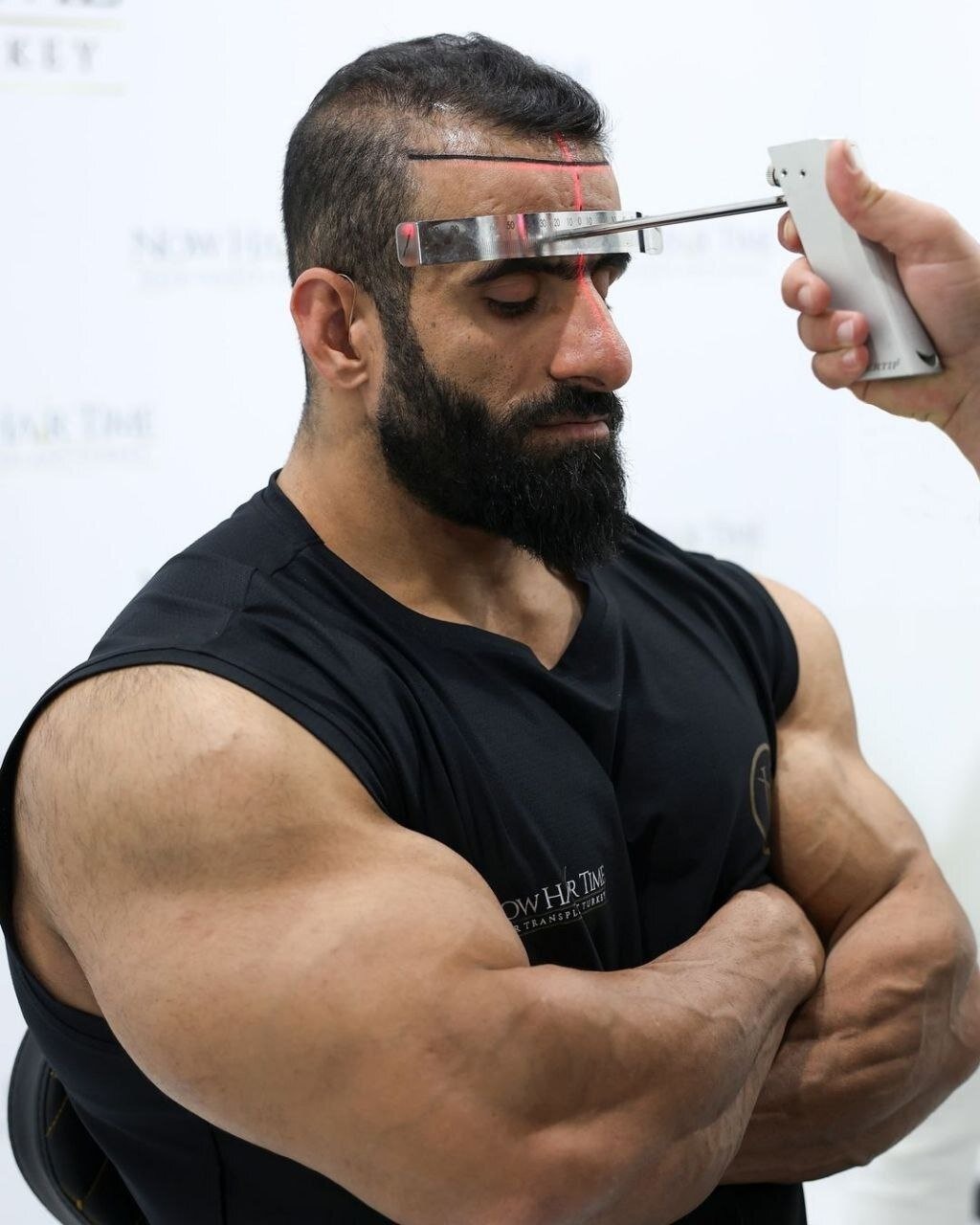 (تصاویر) عکس‌های هادی چوپان پس از کاشت مو در ترکیه