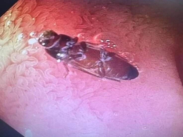 عکسی ترسناک از یک سوسک زنده در روده مرد بدشانس