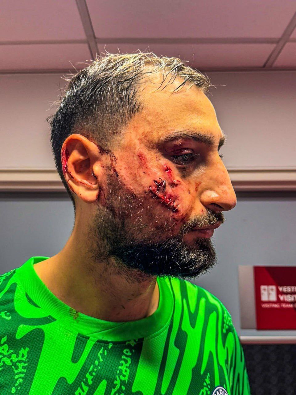 (تصاویر) مصدومیت دلخراش دوناروما در بازی پاری سن ژرمن و موناکو