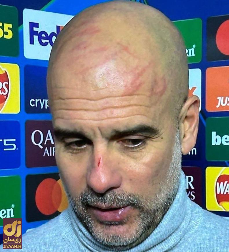 تصویری باورنکردی از صورت زخمی و خونی گواردیولا با خودزنی او بعد از تساوی با فاینورد