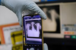 میزان ابتلا به سل پس از کرونا به شکل نگران‌کننده‌ای افزایش یافته است