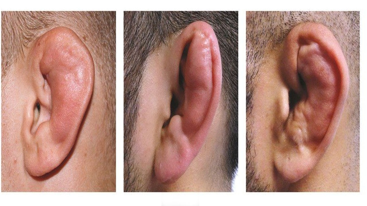 رواج پدیده عجیب شکستن عمدی گوش بین جوانان