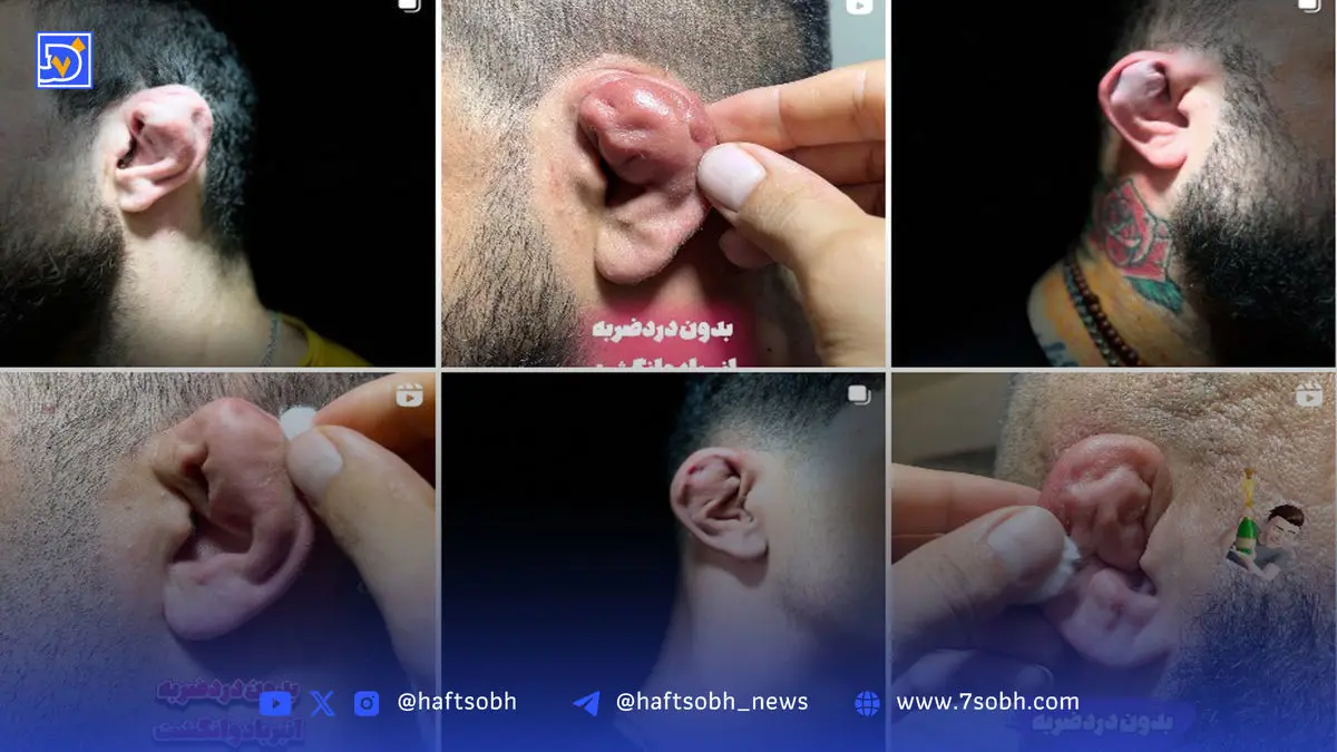 رواج پدیده عجیب شکستن عمدی گوش بین جوانان