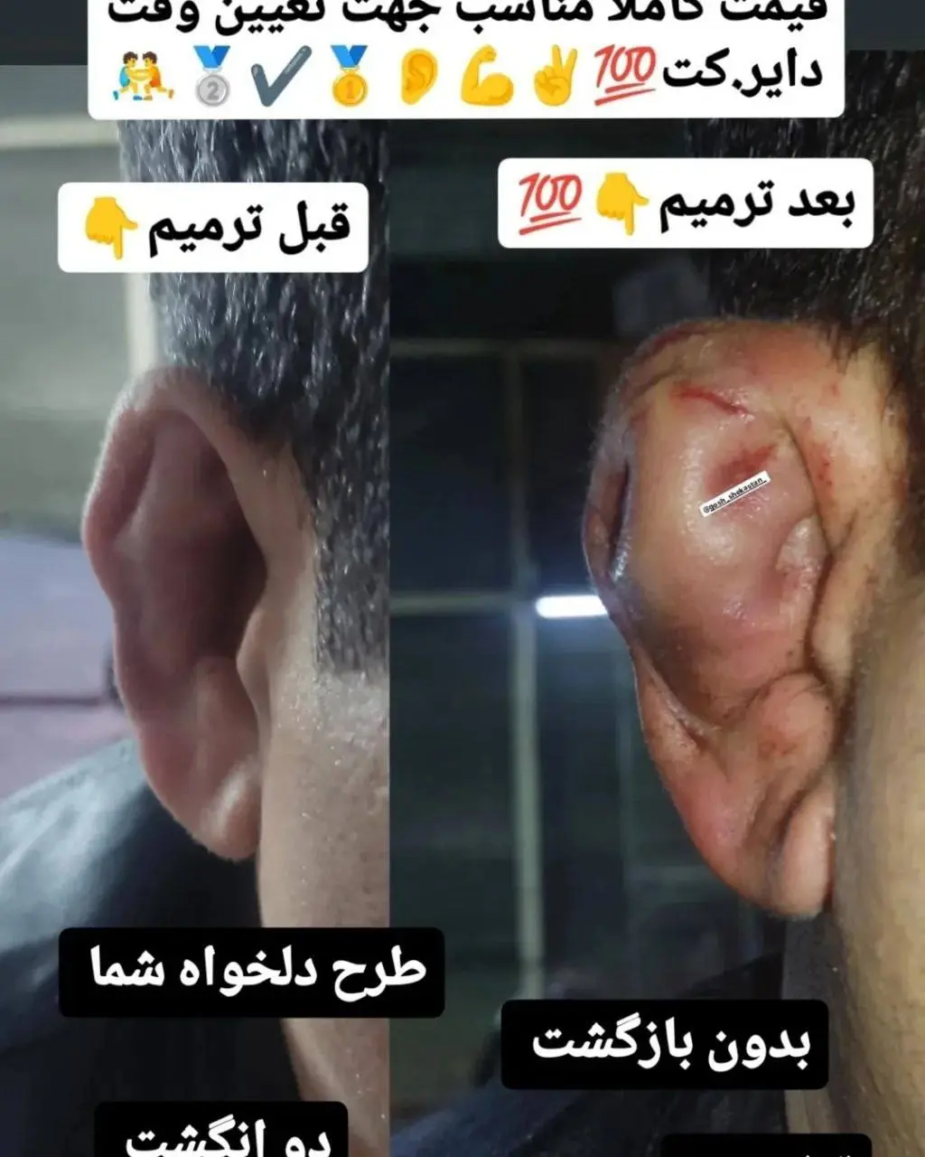 رواج پدیده عجیب شکستن عمدی گوش بین جوانان