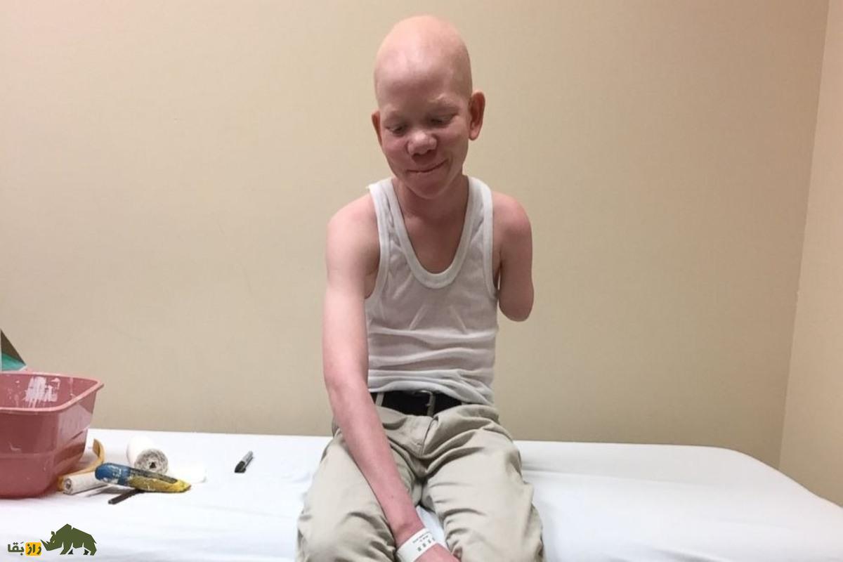 یک کودک زال در آفریقا با دست قطع شده